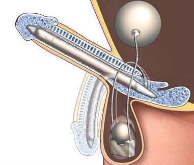 prosthesis to enlarge the penis